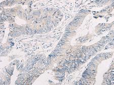 WNK4 Antibody - Immunohistochemistry of paraffin-embedded Human colorectal cancer tissue  using WNK4 Polyclonal Antibody at dilution of 1:45(×200)