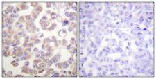 WNT1 Antibody - Immunohistochemistry analysis of paraffin-embedded human breast carcinoma tissue, using WNT1 Antibody. The picture on the right is blocked with the synthesized peptide.