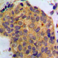 WNT1 Antibody - Immunohistochemical analysis of WNT1 staining in human breast cancer formalin fixed paraffin embedded tissue section. The section was pre-treated using heat mediated antigen retrieval with sodium citrate buffer (pH 6.0). The section was then incubated with the antibody at room temperature and detected using an HRP conjugated compact polymer system. DAB was used as the chromogen. The section was then counterstained with hematoxylin and mounted with DPX.