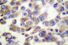 WNT1 Antibody - IHC of WNT1 (G331) pAb in paraffin-embedded human breast carcinoma tissue.