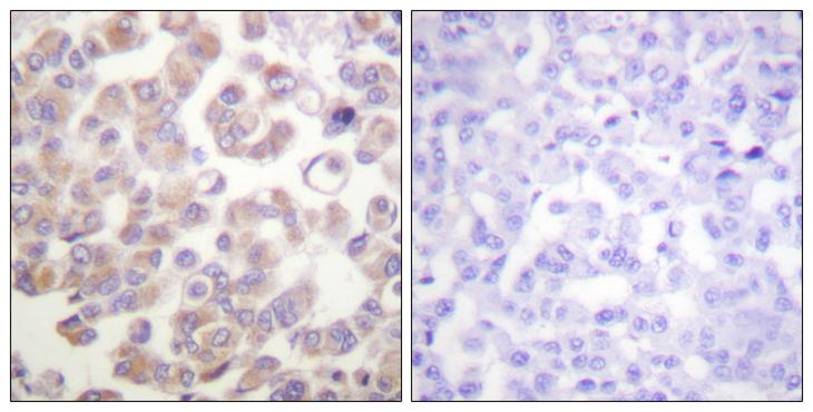 WNT1 Antibody - Peptide - + Immunohistochemistry analysis of paraffin-embedded human breast carcinoma tissue, using WNT1 antibody.