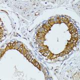 WNT1 Antibody - Immunohistochemistry of paraffin-embedded Human mammary cancer using WNT1 Polyclonal Antibody at dilution of 1:100 (40x lens).
