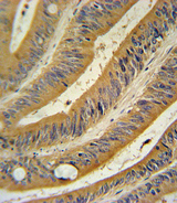 WNT10B Antibody - WNT10B Antibody immunohistochemistry of formalin-fixed and paraffin-embedded human colon carcinoma followed by peroxidase-conjugated secondary antibody and DAB staining.