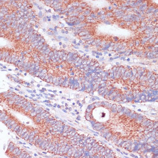 WNT10B Antibody - Immunohistochemistry of paraffin-embedded Human colon carcinoma using WNT10B Polyclonal Antibody at dilution of 1:100 (40x lens).