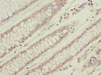 WNT14 / WNT9A Antibody - Immunohistochemistry of paraffin-embedded human colon cancer at dilution 1:100
