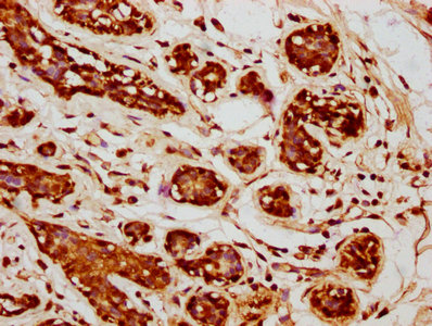 WNT14 / WNT9A Antibody - IHC image of WNT9A Antibody diluted at 1:245 and staining in paraffin-embedded human breast cancer performed on a Leica BondTM system. After dewaxing and hydration, antigen retrieval was mediated by high pressure in a citrate buffer (pH 6.0). Section was blocked with 10% normal goat serum 30min at RT. Then primary antibody (1% BSA) was incubated at 4°C overnight. The primary is detected by a biotinylated secondary antibody and visualized using an HRP conjugated SP system.