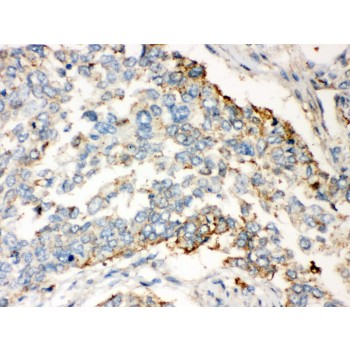 WNT2B Antibody - WNT2B antibody IHC-paraffin. IHC(P): Human Lung Cancer Tissue.