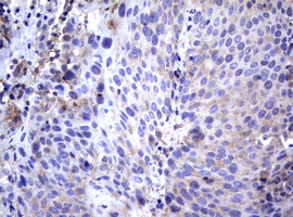 WNT3 Antibody - IHC of paraffin-embedded Carcinoma of Human lung tissue using anti-WNT3 mouse monoclonal antibody. (Heat-induced epitope retrieval by 10mM citric buffer, pH6.0, 120°C for 3min).