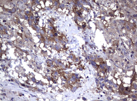 WNT3 Antibody - IHC of paraffin-embedded Adenocarcinoma of Human ovary tissue using anti-WNT3 mouse monoclonal antibody. (Heat-induced epitope retrieval by 10mM citric buffer, pH6.0, 120°C for 3min).