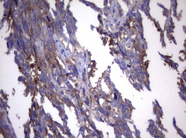 WNT3 Antibody - IHC of paraffin-embedded Adenocarcinoma of Human endometrium tissue using anti-WNT3 mouse monoclonal antibody. (Heat-induced epitope retrieval by 10mM citric buffer, pH6.0, 120°C for 3min).