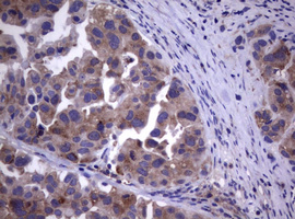 WNT3 Antibody - IHC of paraffin-embedded Carcinoma of Human bladder tissue using anti-WNT3 mouse monoclonal antibody. (Heat-induced epitope retrieval by 10mM citric buffer, pH6.0, 120°C for 3min).