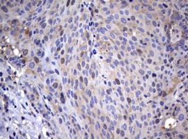 WNT3 Antibody - IHC of paraffin-embedded Carcinoma of Human lung tissue using anti-WNT3 mouse monoclonal antibody.