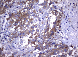 WNT3 Antibody - IHC of paraffin-embedded Adenocarcinoma of Human ovary tissue using anti-WNT3 mouse monoclonal antibody.