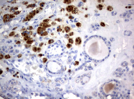 WNT3 Antibody - IHC of paraffin-embedded Carcinoma of Human thyroid tissue using anti-WNT3 mouse monoclonal antibody. (Heat-induced epitope retrieval by 10mM citric buffer, pH6.0, 120°C for 3min).