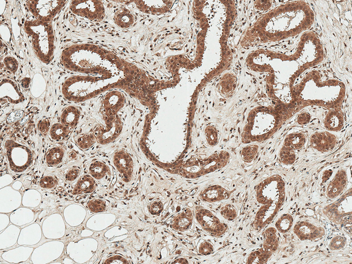 WNT3 Antibody - Immunohistochemistry analysis using Rabbit Anti-WNT3 Polyclonal Antibody. Tissue: Breast. Species: Human. Fixation: Formalin Fixed Paraffin-Embedded. Primary Antibody: Rabbit Anti-WNT3 Polyclonal Antibody  at 1:50 for 30 min at RT. Counterstain: Hematoxylin. Magnification: 10X. HRP-DAB Detection.