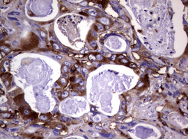 WNT3 Antibody - IHC of paraffin-embedded Adenocarcinoma of Human colon tissue using anti-WNT3 mouse monoclonal antibody.