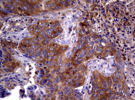 WNT3 Antibody - IHC of paraffin-embedded Carcinoma of Human lung tissue using anti-WNT3 mouse monoclonal antibody.