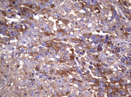 WNT3 Antibody - IHC of paraffin-embedded Adenocarcinoma of Human ovary tissue using anti-WNT3 mouse monoclonal antibody.