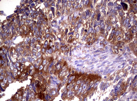 WNT3 Antibody - IHC of paraffin-embedded Adenocarcinoma of Human endometrium tissue using anti-WNT3 mouse monoclonal antibody.