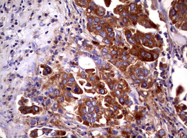WNT3 Antibody - IHC of paraffin-embedded Carcinoma of Human bladder tissue using anti-WNT3 mouse monoclonal antibody.