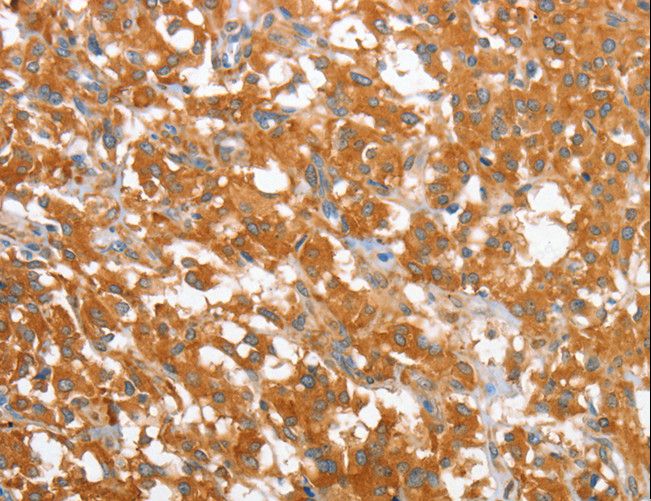 WNT3A Antibody - Immunohistochemistry of paraffin-embedded Human thyroid cancer using WNT3A Polyclonal Antibody at dilution of 1:40.