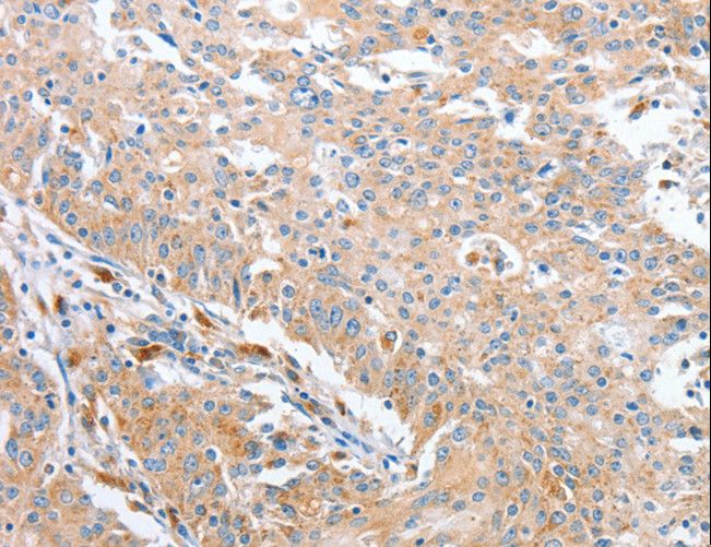 WNT3A Antibody - Immunohistochemistry of paraffin-embedded Human gastric cancer using WNT3A Polyclonal Antibody at dilution of 1:40.