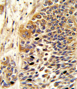 WNT4 Antibody - Formalin-fixed and paraffin-embedded human bladder carcinoma reacted with WNT4 Antibody , which was peroxidase-conjugated to the secondary antibody, followed by DAB staining. This data demonstrates the use of this antibody for immunohistochemistry; clinical relevance has not been evaluated.