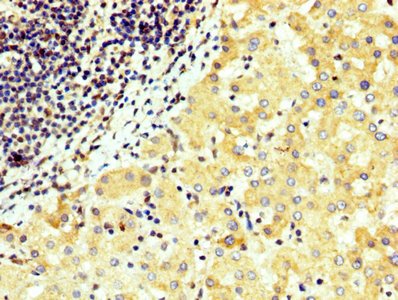 WNT4 Antibody - IHC image of WNT4 Antibody diluted at 1:300 and staining in paraffin-embedded human liver cancer performed on a Leica BondTM system. After dewaxing and hydration, antigen retrieval was mediated by high pressure in a citrate buffer (pH 6.0). Section was blocked with 10% normal goat serum 30min at RT. Then primary antibody (1% BSA) was incubated at 4°C overnight. The primary is detected by a biotinylated secondary antibody and visualized using an HRP conjugated SP system.