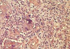 WNT5A Antibody - IHC of human breast tumor tissue using antibody (wnt-5a) at 10 ug/ml.