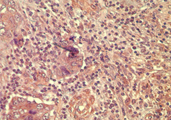 WNT5A Antibody - IHC of human breast tumor tissue using antibody (wnt-5a) at 10 ug/ml.