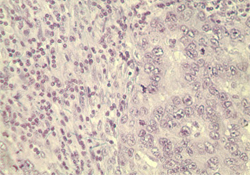 WNT5A Antibody - IHC of human breast tumor tissue using control (rabbit Ig) at 10 ug/ml.