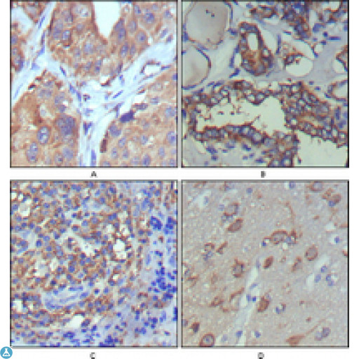 WNT5A Antibody - Immunohistochemistry (IHC) analysis of paraffin-embedded human lung cancer (A), thyroid cancer (B), lymph node (C) and brain (D) showing cytoplasmic and extracellular matrix localization with DAB staining using Wnt-5a Monoclonal Antibody.