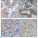 WNT5A Antibody - Immunohistochemistry (IHC) analysis of paraffin-embedded human lung cancer (A), thyroid cancer (B), lymph node (C) and brain (D) showing cytoplasmic and extracellular matrix localization with DAB staining using Wnt-5a Monoclonal Antibody.
