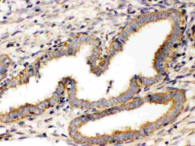 WNT7A Antibody - anti-Wnt7a antibody, IHC(P): Human Endometrial Carcinoma Tissue
