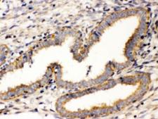 WNT7A Antibody - IHC testing of FFPE human endometrial carcinoma with SLC22A2 antibody. HIER: Boil the paraffin sections in pH 6, 10mM citrate buffer for 20 minutes and allow to cool prior to staining.