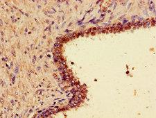 WNT7A Antibody - Immunohistochemistry of paraffin-embedded human prostate cancer using WNT7A Antibody at dilution of 1:100