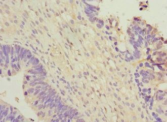 WNT7B Antibody - Immunohistochemistry of paraffin-embedded human ovarian cancer at dilution 1:100