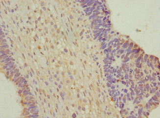 WNT7B Antibody - Immunohistochemistry of paraffin-embedded human ovarian cancer at dilution 1:100