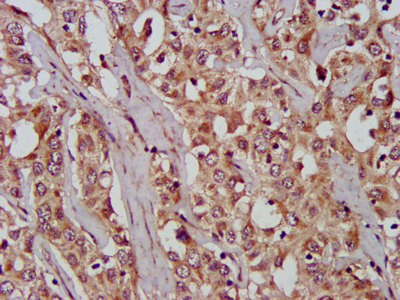 WNT8A Antibody - Immunohistochemistry image at a dilution of 1:200 and staining in paraffin-embedded human liver cancer performed on a Leica BondTM system. After dewaxing and hydration, antigen retrieval was mediated by high pressure in a citrate buffer (pH 6.0) . Section was blocked with 10% normal goat serum 30min at RT. Then primary antibody (1% BSA) was incubated at 4 °C overnight. The primary is detected by a biotinylated secondary antibody and visualized using an HRP conjugated SP system.