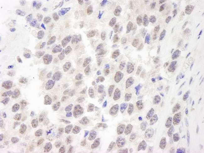 WRN Antibody - Detection of Human WRN by Immunohistochemistry. Sample: FFPE section of human seminoma. Antibody: Affinity purified rabbit anti-WRN used at a dilution of 1:250.