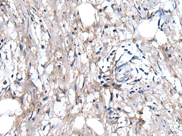 WRN Antibody - Immunohistochemistry of paraffin-embedded Human gastric cancer tissue  using WRN Polyclonal Antibody at dilution of 1:55(×200)