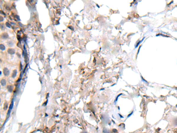 WRN Antibody - Immunohistochemistry of paraffin-embedded Human breast cancer tissue  using WRN Polyclonal Antibody at dilution of 1:55(×200)