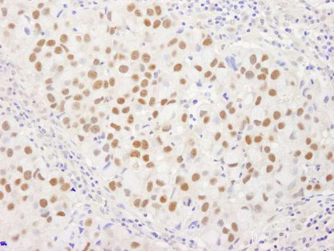 WRNIP1 / WHIP Antibody - Detection of Human WRNIP1 by Immunohistochemistry. Sample: FFPE section of human breast carcinoma. Antibody: Affinity purified rabbit anti-WRNIP1 used at a dilution of 1:250.