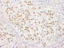 WRNIP1 / WHIP Antibody - Detection of Human WRNIP1 by Immunohistochemistry. Sample: FFPE section of human breast carcinoma. Antibody: Affinity purified rabbit anti-WRNIP1 used at a dilution of 1:250.