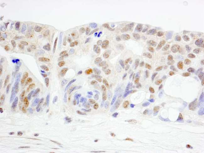 WRNIP1 / WHIP Antibody - Detection of Human WRNIP1 by Immunohistochemistry. Sample: FFPE section of human ovarian carcinoma. Antibody: Affinity purified rabbit anti-WRNIP1 used at a dilution of 1:1000 (1 ug/ml). Detection: DAB.