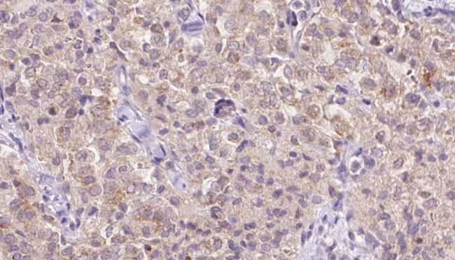 WSB1 Antibody - 1:100 staining human thyroid carcinoma tissue by IHC-P. The sample was formaldehyde fixed and a heat mediated antigen retrieval step in citrate buffer was performed. The sample was then blocked and incubated with the antibody for 1.5 hours at 22°C. An HRP conjugated goat anti-rabbit antibody was used as the secondary.