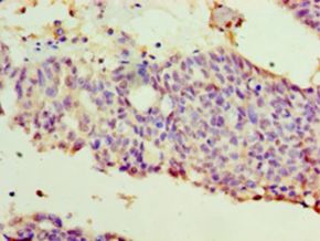 WT1 / Wilms Tumor 1 Antibody - Immunohistochemistry of paraffin-embedded human endometrial cancer using antibody at 1:100 dilution.  This image was taken for the unconjugated form of this product. Other forms have not been tested.