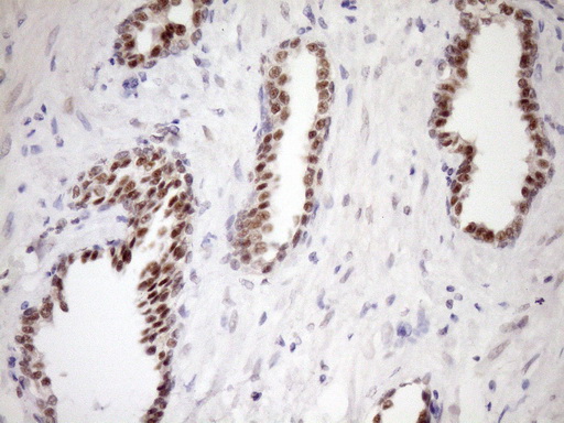 WTAP Antibody - Immunohistochemical staining of paraffin-embedded Carcinoma of Human prostate tissue using anti-WTAP mouse monoclonal antibody. (Heat-induced epitope retrieval by Tris-EDTA, pH8.0)(1:150)