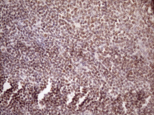 WTAP Antibody - Immunohistochemical staining of paraffin-embedded Human lymphoma tissue using anti-WTAP mouse monoclonal antibody. (Heat-induced epitope retrieval by Tris-EDTA, pH8.0)(1:150)