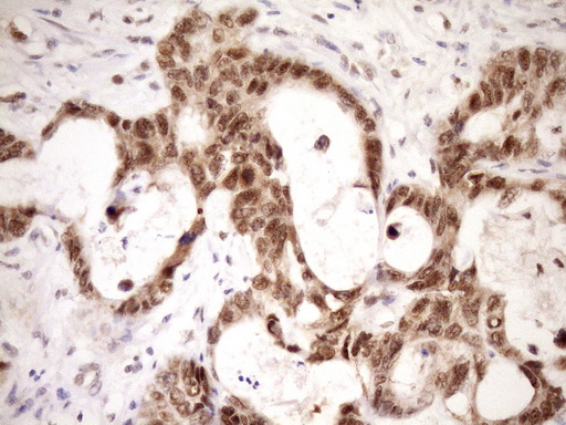 WTAP Antibody - IHC of paraffin-embedded Adenocarcinoma of Human colon tissue using anti-WTAP mouse monoclonal antibody. (Heat-induced epitope retrieval by Tris-EDTA, pH8.0)(1:150).